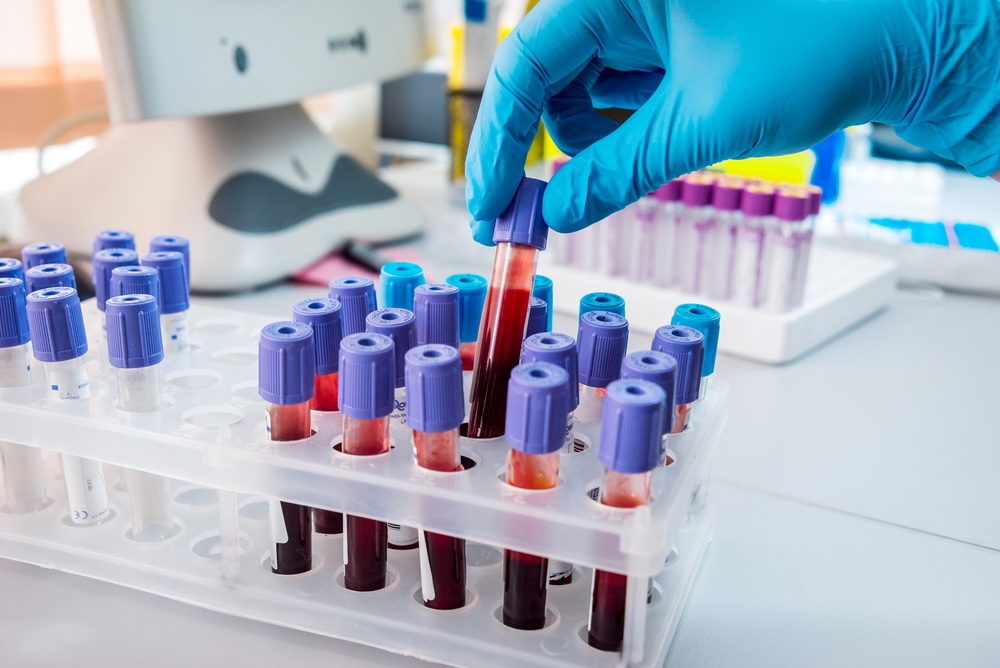 How Long Does Cocaine Stay in your Blood? 2 blood samples