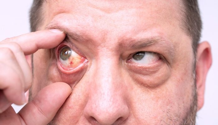 5 Signs of Cocaine Eyes A close-up of a man's face with red eyes due to cocaine abuse