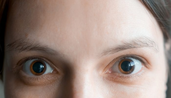 5 Signs of Cocaine Eyes A close-up of a woman's face with dilated eyes due to cocaine addiction